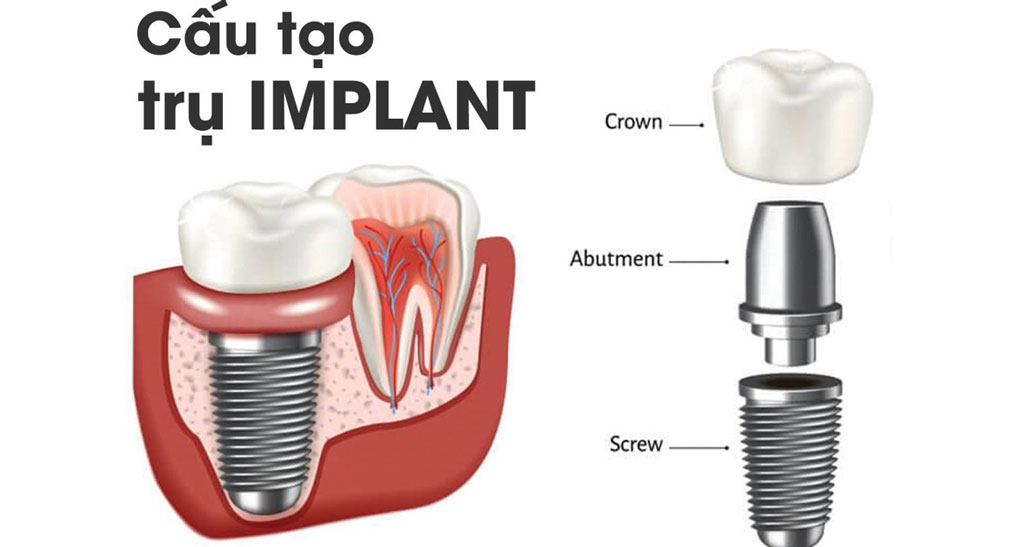 cấu tạo trồng răng implant