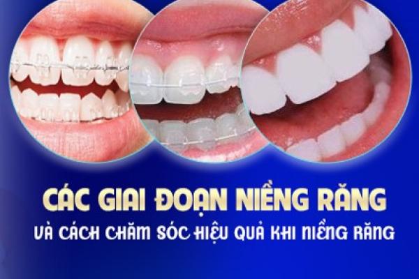   
          Giai đoạn nào xấu nhất khi niềng răng?