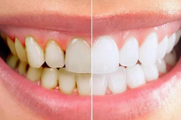   
          Lấy cao răng xong bị tụt lợi nguyên nhân do đâu?
