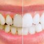   
          Lấy cao răng xong bị tụt lợi nguyên nhân do đâu?