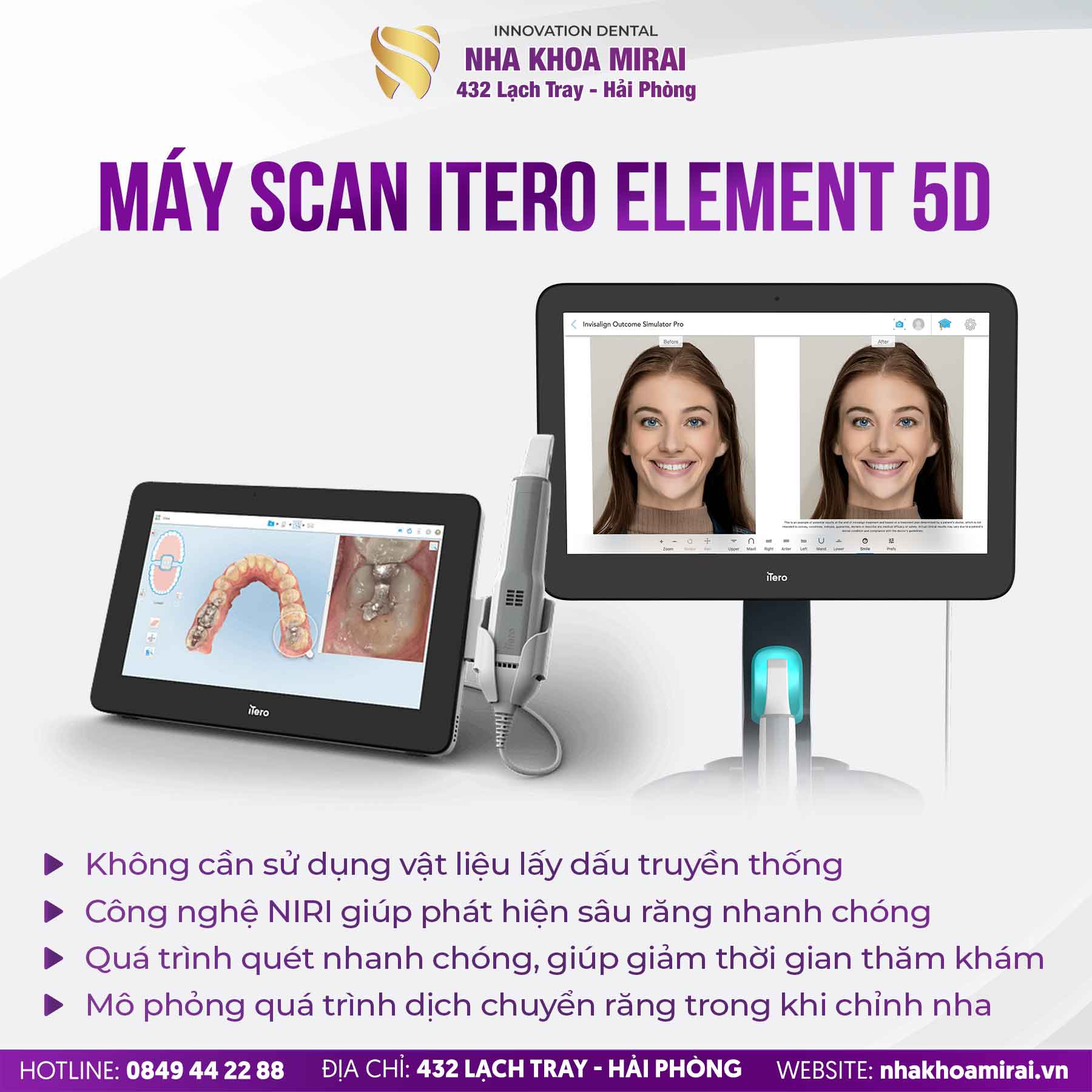 Nên Dán Sứ Hay Bọc Sứ