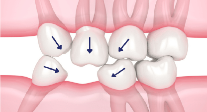 Mất răng khiến sai lệch khớp cắn